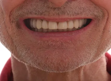 Smil etter behandling 6